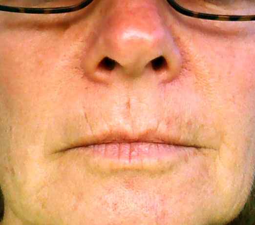 Restalyne_before